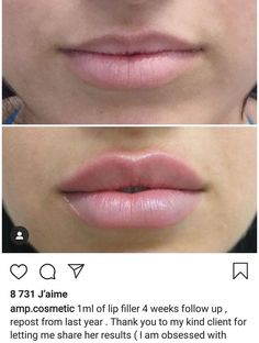 Different Styles Of Lip Filler, Hollywood Lips Filler, Lip Filler 2ml, Lip Filler Shape Ideas Pouty, Lip Filler Shape Ideas 1ml, Lip Fillers Before And After 1ml Russian, Keyhole Pout Lips, Lip Filler 1 Syringe, Lips Before And After Injections