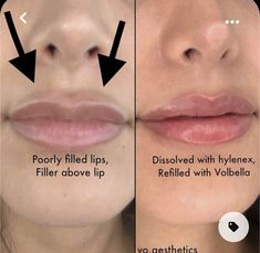 Lip Fillers Juvederm, Lips Inspiration, Hyaluronic Acid Fillers, Facial Fillers, Cosmetic Injectables, Lip Augmentation