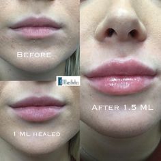 Dermal Fillers Lips, Hyaluronic Acid Lips, Face Fillers, Botox Lips, Facial Contouring, Lip Augmentation, Facial Aesthetics, Lip Enhancement