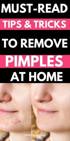 Overnight Pimple Remedies, Healthy Clear Skin