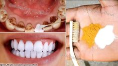 Secret that Dentists don't want you to know: Remove Tartar and Teeth Whitening in just 2 minutes Baking Soda Teeth, Natural Teeth Whitening Diy, Natural Teeth Whitening Remedies, Baking Soda Teeth Whitening, Teeth Whitening Homemade, Black Teeth, Teeth Whitening Remedies, Teeth Whitening Diy