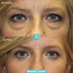 Upper Blephoraplasty, Lower Blephoraplasty Surgery, Upper Eye Lid Surgery Before And After, Blethoplasty Before And After, Eye Lid Surgery Before And After, Upper Blephoraplasty Before And After, Eye Lift Surgery, Facial Procedure, Skin Tightening Treatments