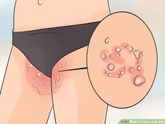 Related image Groin Rash, Inner Thigh Rash, Heat Rash Remedy, Body Rash, Rashes Remedies, Red Rash, Natural Mouthwash, Itchy Rash, Heat Rash