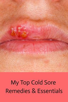 Save this pin to discover my top cold sore remedies to get rid of a cold sore fast! From soothing creams to essential oils, these are the cold sore treatments and products I keep on hand at all times. Canker Sore, Dermatology