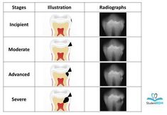 Dental Assistant School, Dental Assistant Study, Dental Hygiene Student, Sensitive Teeth Remedy, Dental Decay, Dental Anatomy