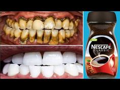 Teeth Whitening In 1 Minute Remove Yellowing And Tartar Falls After Rubbing Your Teeth With It - YouTube Teeth Tartar Removal, Baking Soda Teeth, Diy Teeth, Natural Teeth Whitening Remedies, Black Teeth