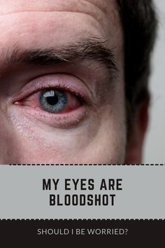 Have you ever woken up to find your eyes bloodshot and panicked? Fear not, we've got you covered. In this article, we'll explore the possible causes behind bloodshot eyes, determine whether you should be worried, and provide some helpful tips for alleviating the discomfort. Let's get started and find the relief you deserve. Blood In Eye, Swollen Eyes From Allergies, Bloodshot Eye, Swollen Eyelid, Eye Diseases Types Of, Eyesight Problems