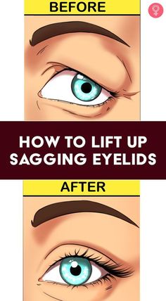 Sagging Eyes Remedies, Saggy Eyes Remedies, Saggy Eyelids Remedies, How To Fix Droopy Eyelids, Sagging Eyelids Natural Remedies, Eye Lid Lift Droopy Eyelids, Tighten Eyelids, Swollen Eyelids Remedy, Saggy Eyes