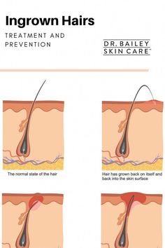 Ingrown hair treatment and prevention with skin care kits, retinol and tips from Dermatologist Cynthia Bailey MD. Ingrowing Hair, Natural Hair Removal Remedies, Ingrown Hair Remedies, Waxing Tips, Sugaring Hair Removal