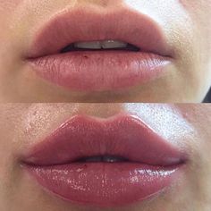 Juvederm Lips, Permanente Make-up, Lip Augmentation