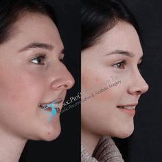 Rhinoplasty Gallery | Assoc. Prof. Dr. Suleyman TAS Nose Surgery, Nose Shapes, Turkey Istanbul