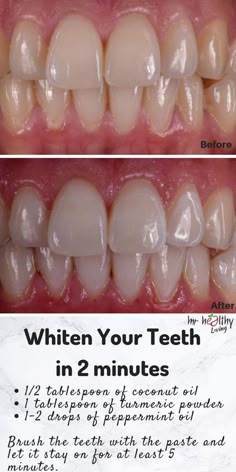 Turmeric Teeth Whitening, Teeth Whitening Methods, Diy Teething, Teeth Health, Gum Health, Natural Teeth Whitening