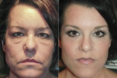 touched. Hollow Eyes, Cheek Implants, Laser Surgery