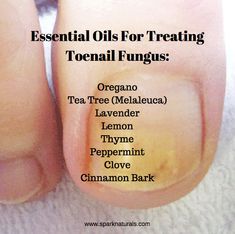 Oils that have anti bacterial and anti fungal properties and may help in treating toenail fungus are : Oregano, Tea Tree, Lavender, Lemon, Thyme, Peppermint, Clove, and Cinnamon Bark. Oregano Tea, Treating Toenail Fungus, Tea Tree Oil Face, Essential Oil Remedy, Lemon Thyme, Oil Remedies, Fungal Nail, Essential Oils Herbs, Lavender Lemon