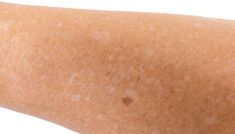 Dark Spots on Legs: Causes and 7 Treatments White Skin Spots, Dark Spots On Legs, Spots On Legs, Combination Skin Type, Skin Spots, Anti Aging Ingredients, Sagging Skin, Skincare Ingredients