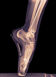 an x - ray image of the foot and lower leg with bones highlighted in white