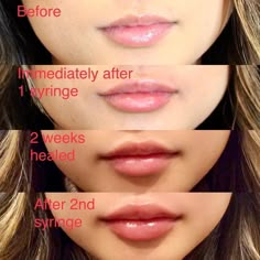 1 Syringe Lip Filler, Get Fuller Lips Naturally, Restylane Lips, Juvederm Lips, Fuller Lips Naturally, Face Fillers, Beauty Procedures