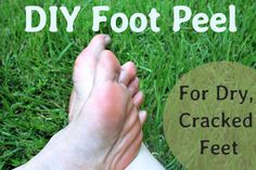 With summer in full swing, learn how you can get your feet beach ready with a foot peel made from ingredients in your bathroom cabinet! Homemade Foot Mask, Diy Foot Peel, Cracked Heels, Peeling Skin, Homemade Face Masks, Homemade Face