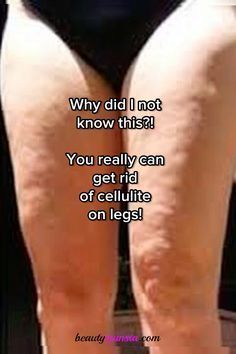 How To Get Rid Of Leg Dimples, Tighten Leg Skin, Tighten Thigh Skin, Saggy Legs Workout, Firm Legs In Two Weeks, Cottage Cheese Legs How To Get Rid Of, How To Get Rid Of Cellulight, Exercise For Celulites, Fat Legs How To Get Rid Of