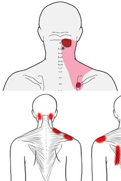 Sometimes with stif neck. Self-care including activities to change or avoid, strategies for relief, exercises for longer-lasting change, yoga, more. Recipe Ideas, Self Care, Yoga