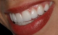 Smile by Dr. David Hornbrook, ceramic artistry by Gold Dust Aesthetic team Dust Aesthetic, Teeth Aesthetic, Teeth Dentist, Jessica Hart, Aesthetic Dentistry