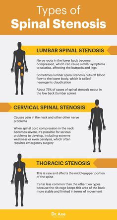 Stenosis Exercises, Nerve Problems, Back Pain Remedies, Spine Health, Sciatic Nerve Pain, Carpal Tunnel, Nerve Pain, Sciatica, Health Info