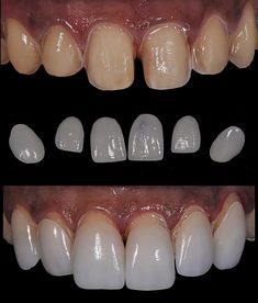 Teeth Makeover, Dentist Clinic, Dental Photography, Windows To The Soul, Veneers Teeth, Dental Anatomy