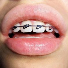 #Structuredmag (by @gabbois) Cute Braces Colors, Braces Tips, Getting Braces, Braces Girls, Invisible Braces, Cute Braces, Brace Face, Braces Colors, Dental Braces