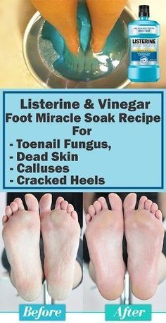 Pin on Home Remedys Listerine Foot Soak, Foot Soak Recipe, Cracked Heels, Foot Soak, Toenail Fungus, Beauty Remedies, Skin Care Remedies, Foot Care, Health And Beauty Tips