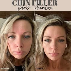 Botox In Chin, Face Balancing Fillers, Facial Balancing Filler, Chin Fillers Before After, Facial Swelling, Facial Balancing, Jaw Reduction Surgery, Jawline Goals, Aesthetic Procedures