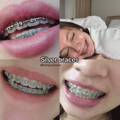 Braces With No Color, Braces On Small Teeth, Grey Braces Color, Braces Colors Lavender, Silver Braces Color, Clear Braces Aesthetic, Cute Braces Colors For Brown Skin, Braces Colors That Make Teeth Look White