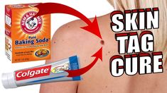 Skin Tags On Face, Disney Savings, Remove Skin Tags, Remove Skin Tags Naturally, Baking Soda Benefits, Tag Remover, Mole Removal, Skin Tags, Magical Herbs