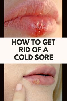 How to get rid of a cold sore fast