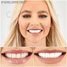 Tooth Crown, Composite Veneers, Teeth Pictures, Dental Logo, Nice Teeth