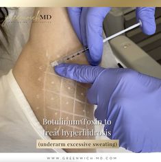 𝐁𝐨𝐭𝐮𝐥𝐢𝐧𝐮𝐦 𝐓𝐨𝐱𝐢𝐧 to treat 𝘩𝘺𝘱𝘦𝘳𝘩𝘪𝘥𝘳𝘰𝘴𝘪𝘴 (underarm excessive sweating)⁣ ⁣ 💉 Treatment: 60 units⁣ 🤩 Decrease the sweating and reduce odor⁣ ⏳ Results after 2 weeks,⁣ 😎 Technique: superficial, intradermal injections of the toxin⁣ 💊 Anesthesia: none⁣ 👄 Recovery: allow 1-2 weeks to completely heal⁣ ⁣ 📲 Link in bio to schedule your appointment⁣ 🔖 Bookmark this picture for reference⁣ ⁣ ⁣ #excessivesweating #botox #underarmbotox #greenwichmd #reducesweating Botox For Sweating, Botulinum Toxin, Aesthetic Medicine, Botox Fillers, Facial Aesthetics, Botox Injections, Excessive Sweating, Medical School Essentials, Medical Spa