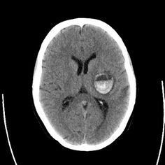 an mri scan shows the area where there are two areas in the left side of the brain