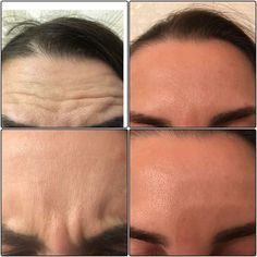 Botox Before And After, Botox Cosmetic, Skin Photo, Celebrity Plastic Surgery, Botox Fillers