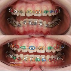 Braces Colors Combinations, Braces Aesthetic, Braces Journey, Red Braces, Black Braces, Cute Braces Colors, Adult Braces