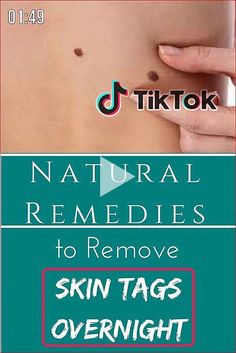 Remove Moles Naturally, How To Remove Moles, Remove Moles, Skin Moles, Type Of Skin, Cold Sores Remedies, Healthy Advice