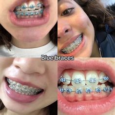 Brasses Teeth Color, Color Of Braces Ideas, Braces Sky Blue, Blue Braces Aesthetic, Blue Braces Colors, Braces Inspo Aesthetic, Pink And Blue Braces, Periwinkle Braces