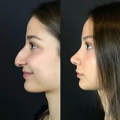 Plastic Surgery Gone Wrong, Rhinoplasty Before And After, Big Nose Beauty