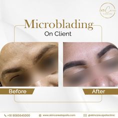 Bye-Bye Sparse Brows! Check out the stunning before and after microblading results at Skincare at Apollo. Ready for your own brow makeover? ✨ 👉 Book your appointment today at Skincare at Apollo! 📞 Call us at +91-9085645000 #Microblading #EyebrowTransformation #SkincareAtApollo #PerfectBrows #BookNow Sparse Brows, Perfect Brows, Book Your Appointment, Cosmetology, Bye Bye, Microblading, Eyebrows