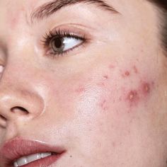 Nodular Acne, Remove Skin Tags Naturally, Face Mapping Acne, Nuh Uh, Face Mapping, Natural Acne, Acne Causes, Oil Spill