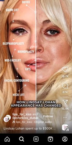 Endoscopic Brow Lift, Botox Brow Lift, Facial Contouring, Neck Lift, Brow Lift, Lindsay Lohan, Facial, Lips