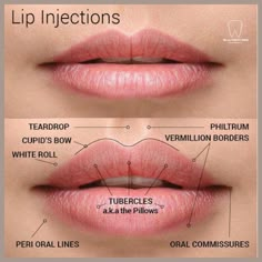 Lip Injections Juvederm, Dermal Fillers Lips, Derma Fillers, Lips Inspiration, Lip Types, Face Fillers, Botox Lips, Facial Fillers, Cosmetic Injectables