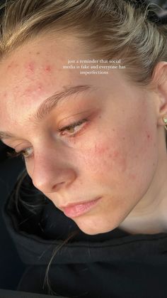 Kayli Boyle, Natural Remedies For Acne, Lemon Face Mask, Remedies For Acne, Acne Makeup, Moisturizer For Oily Skin, Love Your Skin