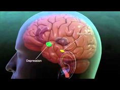 Deep Brain Stimulation explanation | Repinned by @drbrunogallo Brain Development Stages, Brain Neurons Video, Cerebrovascular Disease, Brain Waves Neuroscience, Brain Facts, Brain Function