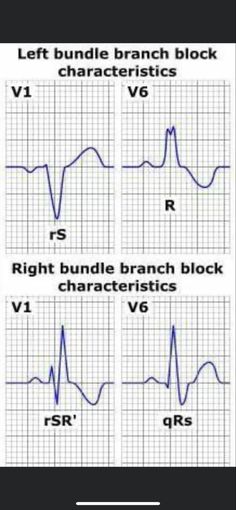 Cardiac Monitoring Nursing, Cardio Assessment Nursing, Cardiogenic Shock Nursing, Cardiac Assessment Nursing, Telemetry Nursing, Normal Ecg, Emt Study