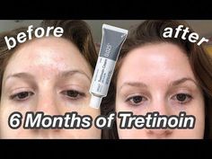 My 6 month Tretinoin update! ~ S U B S C R I B E ~ TIME STAMPS0:00 Intro1:35 What is Tretinoin? 2:37 My skin type5:12 Progress photos6:23 The purge11:06 Skin... Tretonion Before And After, Retin A Before And After Wrinkles, Argireline Solution 10% Before And After, Retin A Cream, Before And After Retinol, Retin A Routine, Triamcinolone Acetonide Cream Uses, Tretinoin Before And After Wrinkles, How To Apply Tretinoin Cream