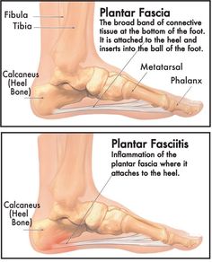 Planters Fasciitis, Shin Splint Exercises, Shin Splints, Medical Terms, Best Running Shoes, Foot Pain